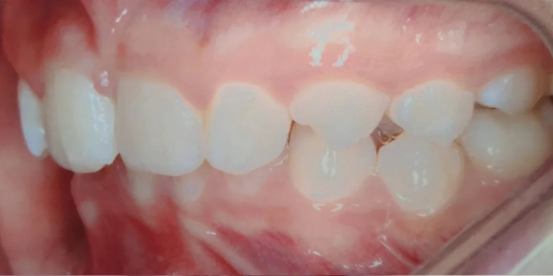 Antes do tratamento: dentes de baixo encavalados e mordida cobrindo os dentes da frente