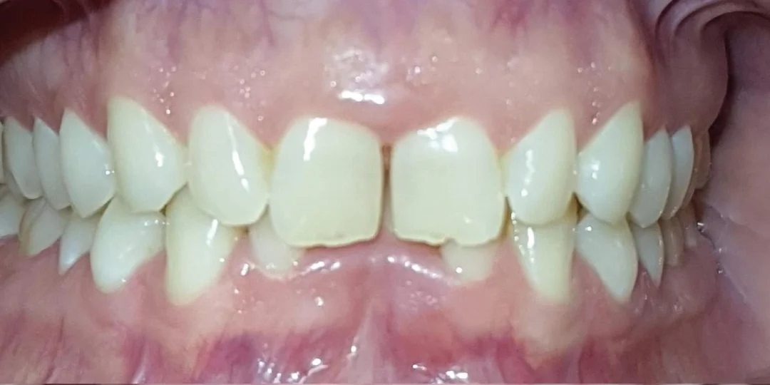 Antes do tratamento: mordida cobrindo demais e dentes encavalados
