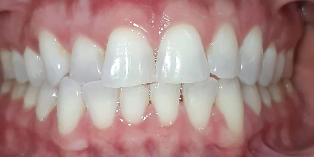 Antes do tratamento: mordida de topo e dente cruzado para dentro
