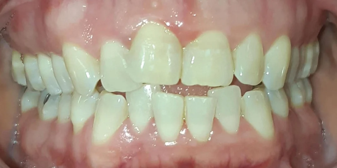 Antes do tratamento: mordida aberta e dentes encavalados